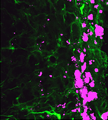 Reprogrammed stem cells (green) chase down and invade glioblastoma cells (pink)